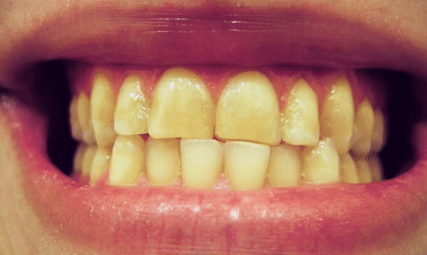 yellow teeth